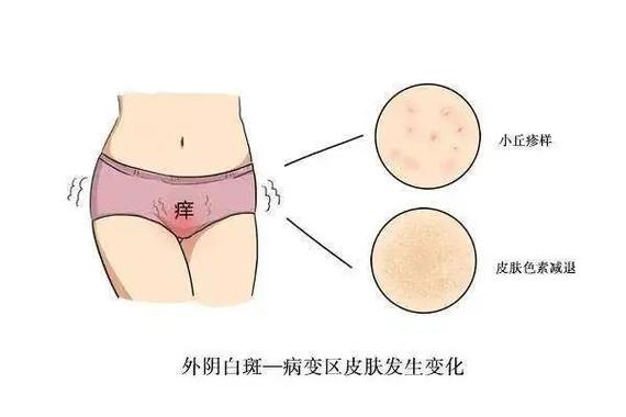 妇科白斑是什么样子:妇科白斑是什么样子图片