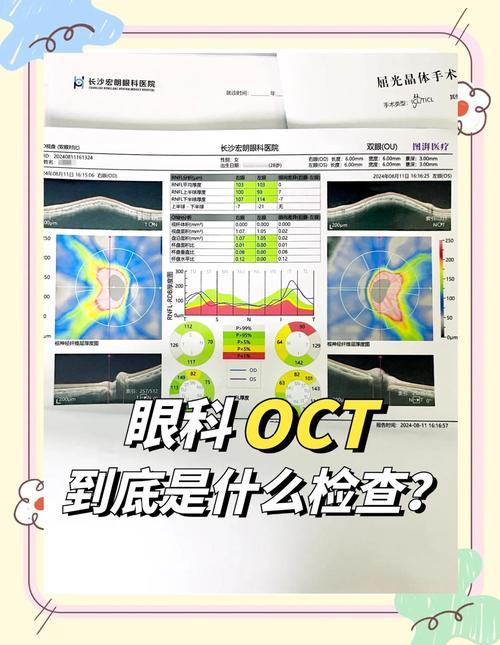 ped在眼科的意思:眼睛ped是啥病严重吗